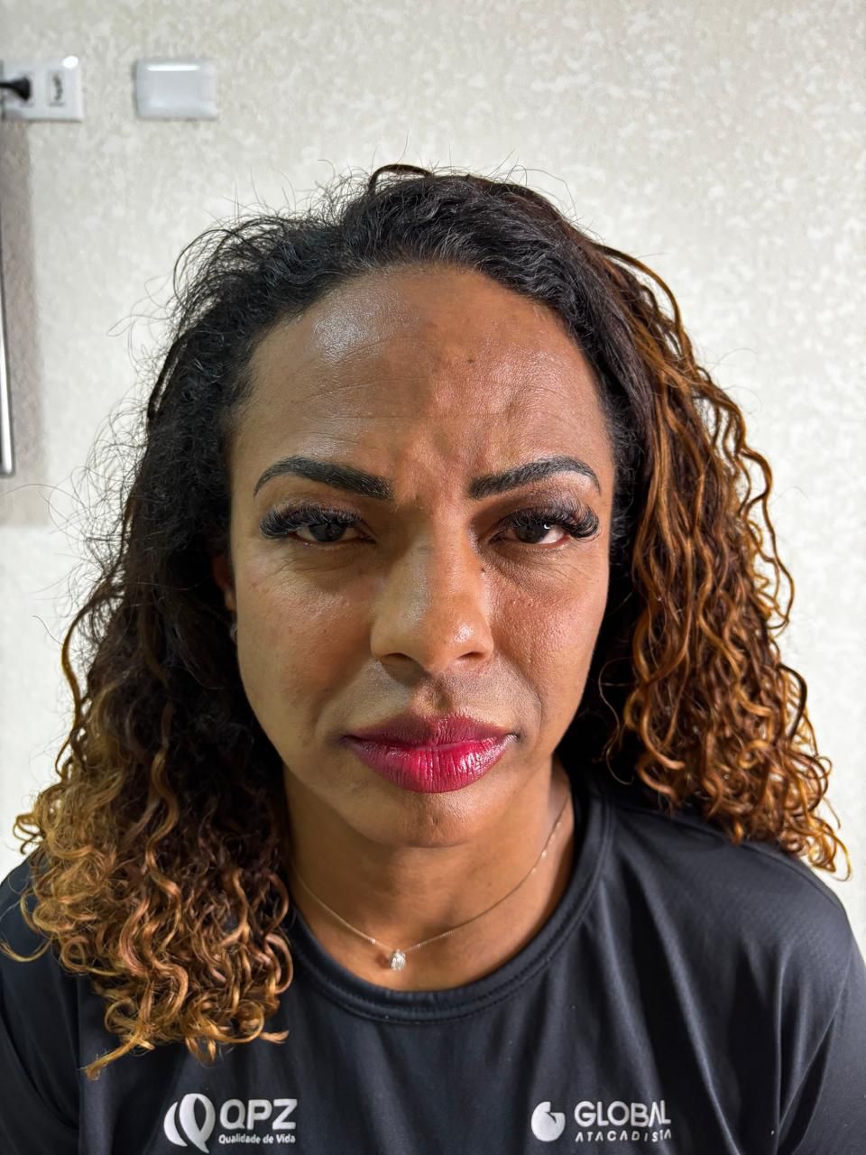 Antes do tratamento Fullface - Dra Vera Lopes