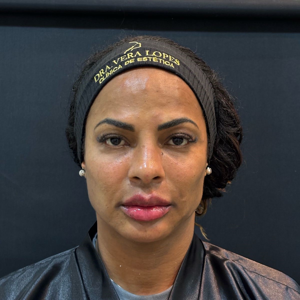 Depois do tratamento Fullface - Dra Vera Lopes