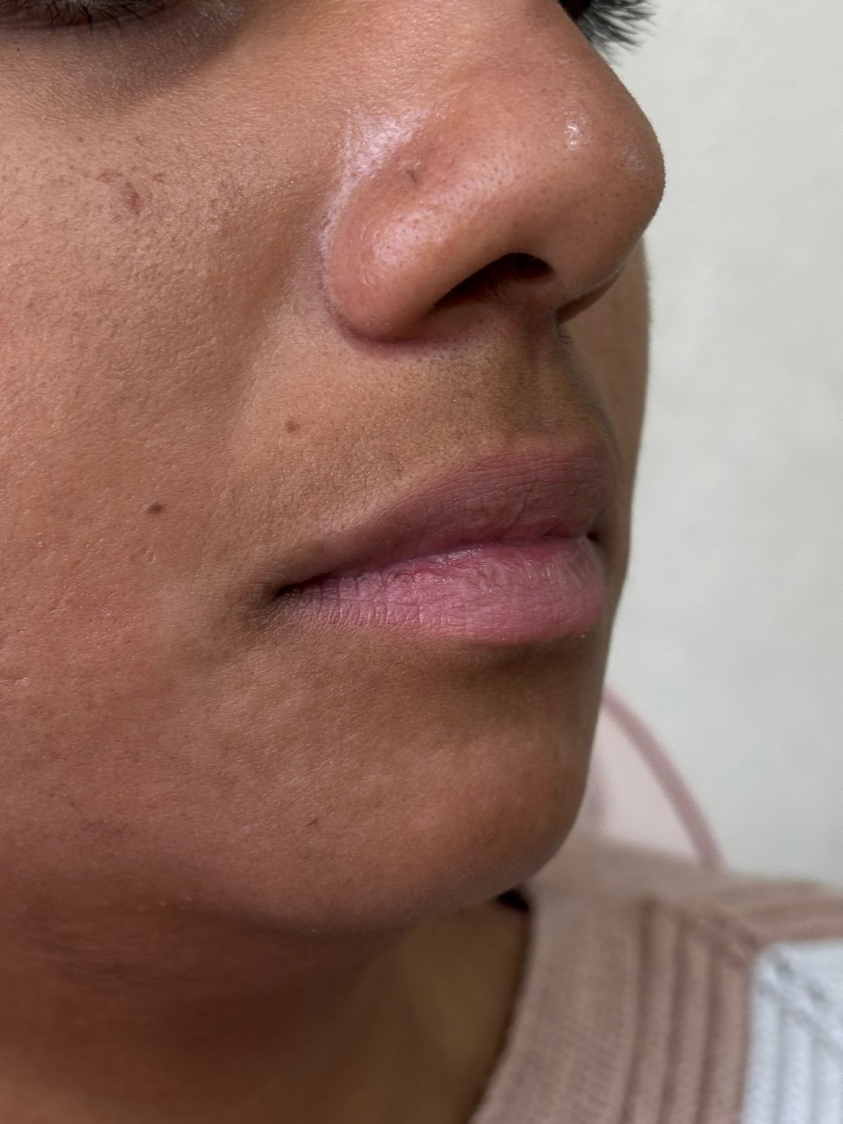 Antes do Preenchimento Labial