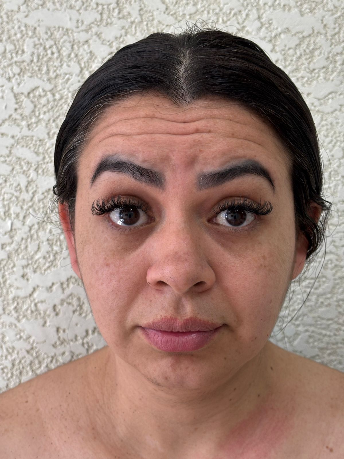 Antes do Preenchimento Labial e Botox