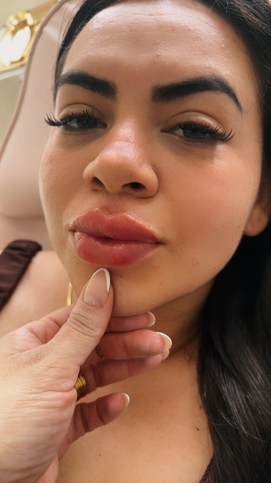 Depois do Preenchimento Labial e Botox